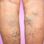 Varicose-Veins