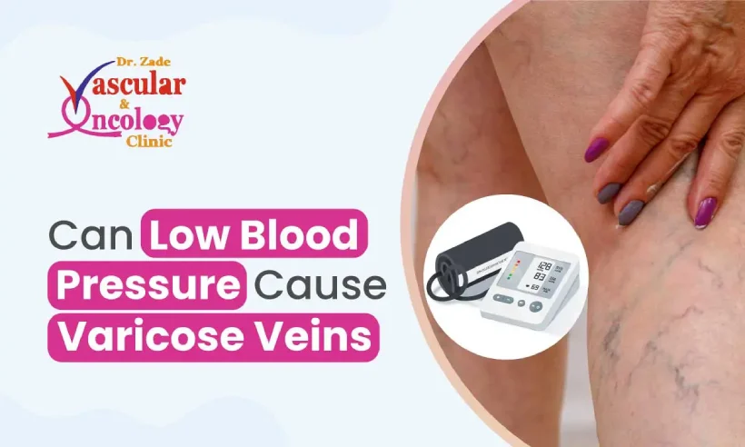 Low Blood Pressure and Varicose Veins