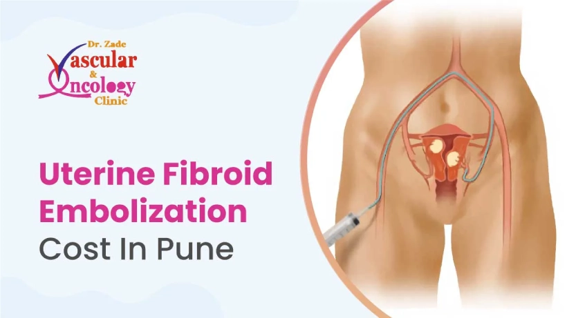 Uterine-Fibroid-Embolization-UFE-Cost-In-Pune