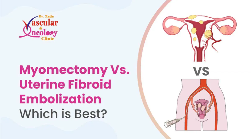 myomectomy vs uterion fibroid embolization