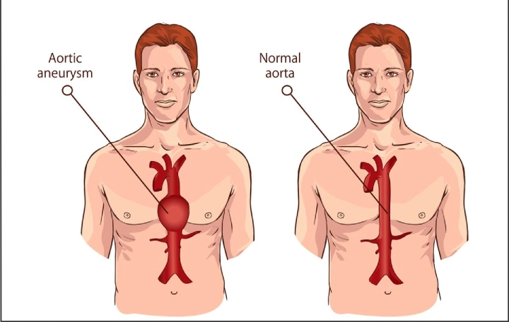 Aortic Aneurysm