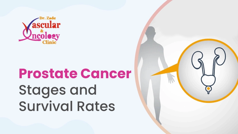 Prostate Cancer Stages and Survival Rates