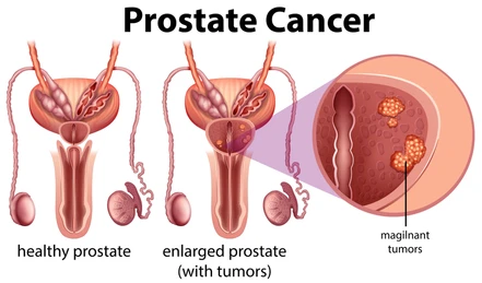 Prostate Cancer Treatment in Pune