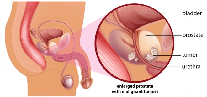 Prostate cancer