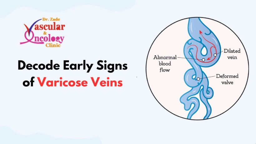 Decode Early Signs of Varicose Veins for Better Health