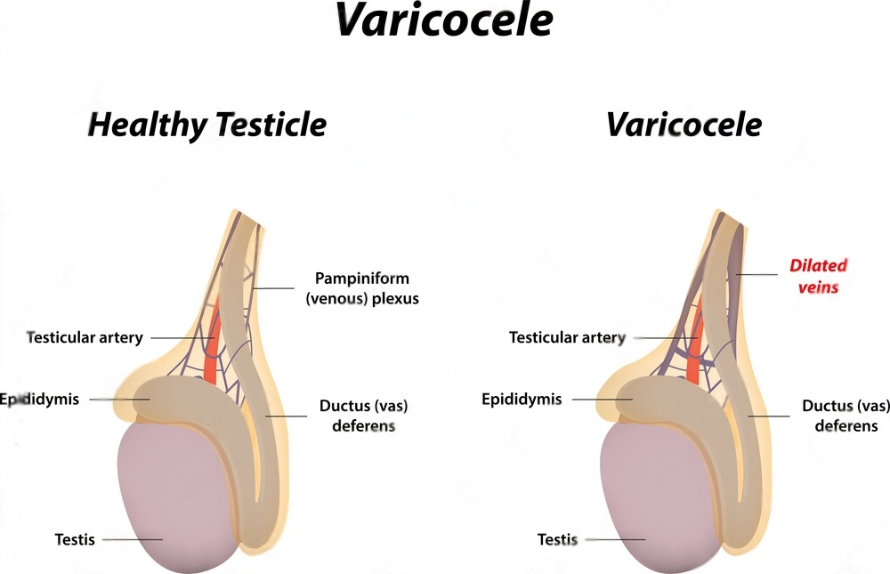 Varicocele Treatment in Pune