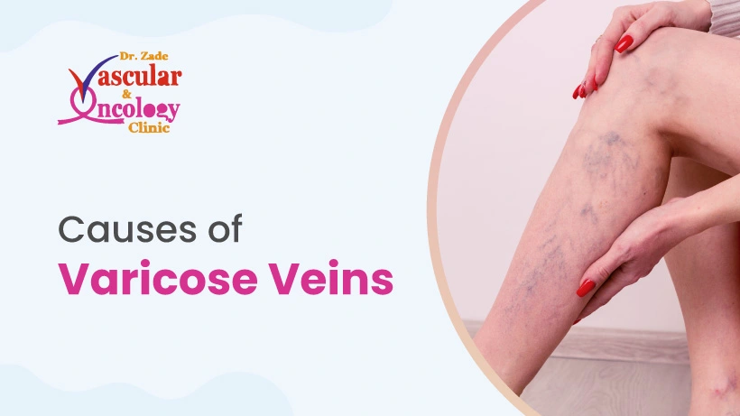 Causes of Varicose Veins